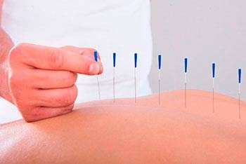 Acupuntura en Quito - Encuentra especialistas en acupuntura