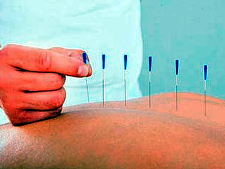 Acupuntura en Quito